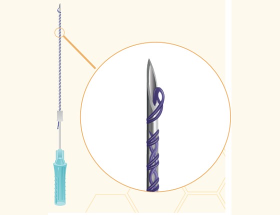 Honey Derma Thread DOUBLE SCREW PDO