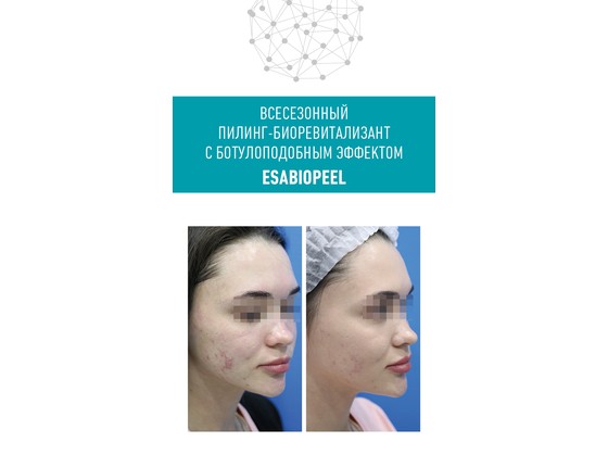 Пилинг ESABIOPEEL, всесезонный пилинг-биоревитализант с ботулоподобным эффектом, раствор